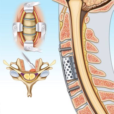 Ilustração médica de cirurgia na coluna vertebral